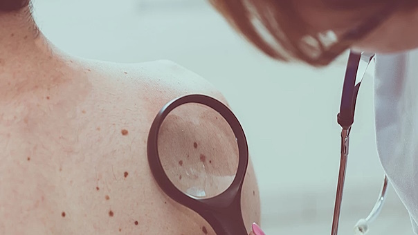 Elke dag een beetje vitamine D halveert je kans op melanoom
